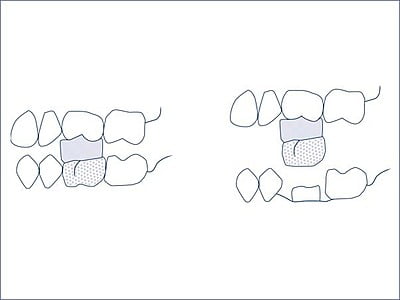 Gripit Arranca coronas adhesivo Gripit Arranca coronas adhesivo