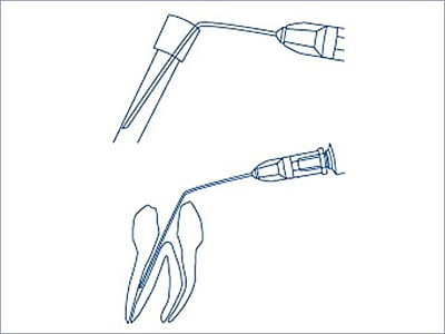 Miraject Endo Luer Miraject Endo Luer