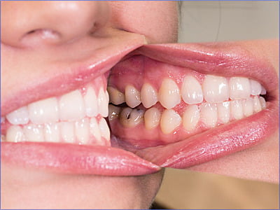 Espejo fotografía intraoral Reflect-Rhod Espejo fotografía intraoral Reflect-Rhod