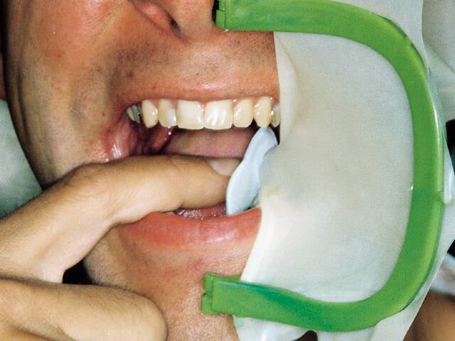 Arco de young plástico Fit Rubberdam Arco de young plástico Fit Rubberdam